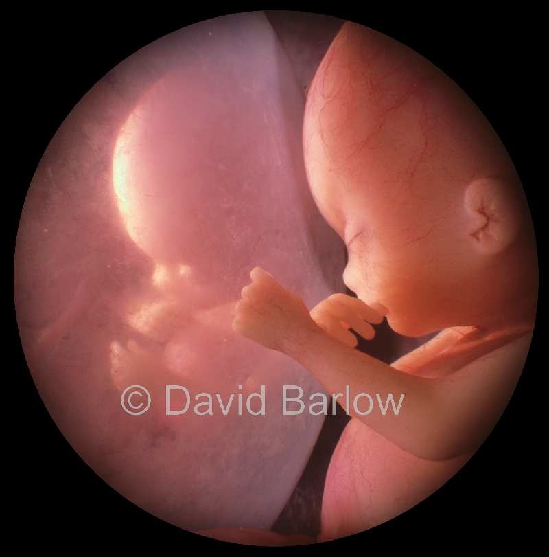 Twin 12 week embryos